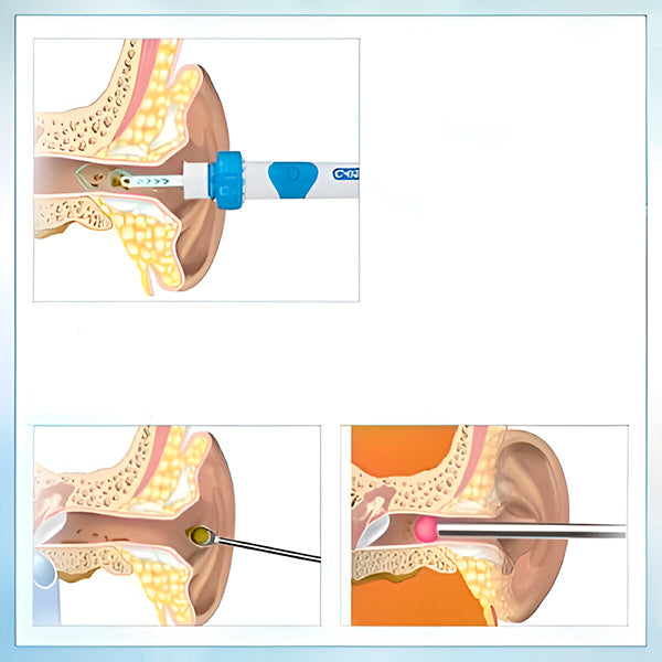 Aspirator pentru Ceară Urechi